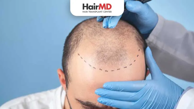 What is FUE Hair Transplant? Everything You Need to Know