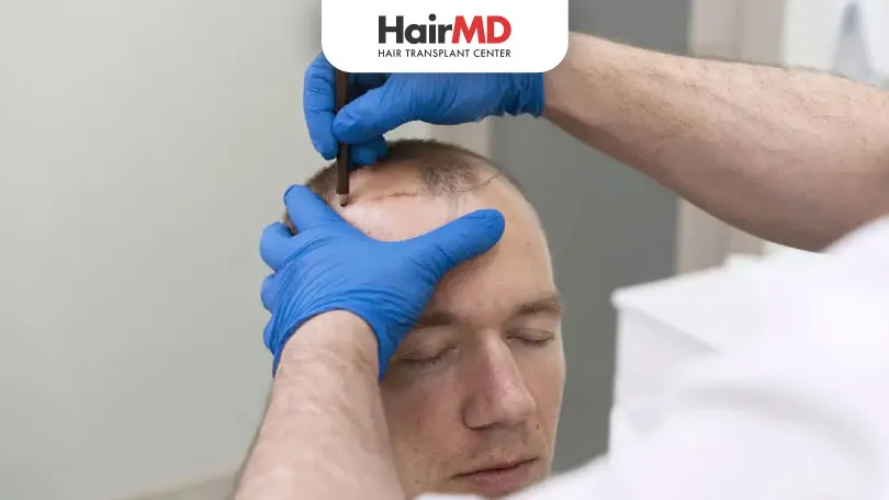 What is the FUE hair transplant procedure HairMD Pune