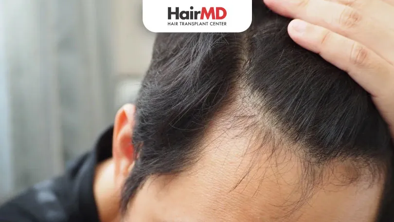 Home Remedies vs. Specialist Treatments for Baldness: What Works Best?