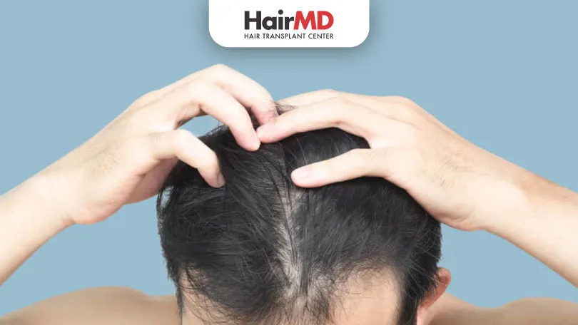 What Is Minoxidil Shedding?