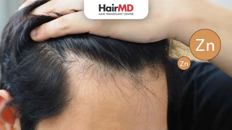 Zinc Deficiency Causes Hair Loss. Know Why!