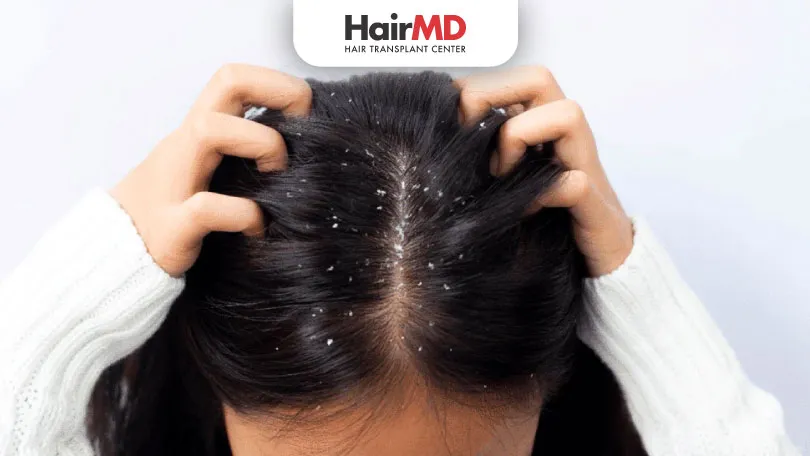 Dandruff Fungus Treatment