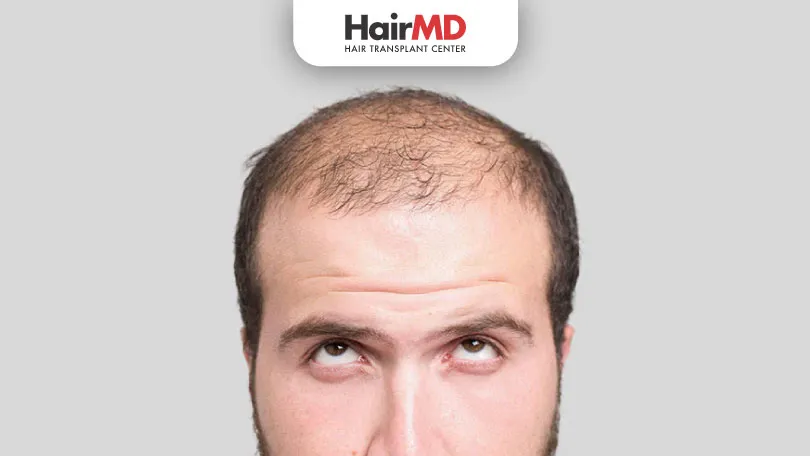 पुरुषां मध्ये टक्कल पडण्याची कारणे व उपचार (Male Pattern Baldness)