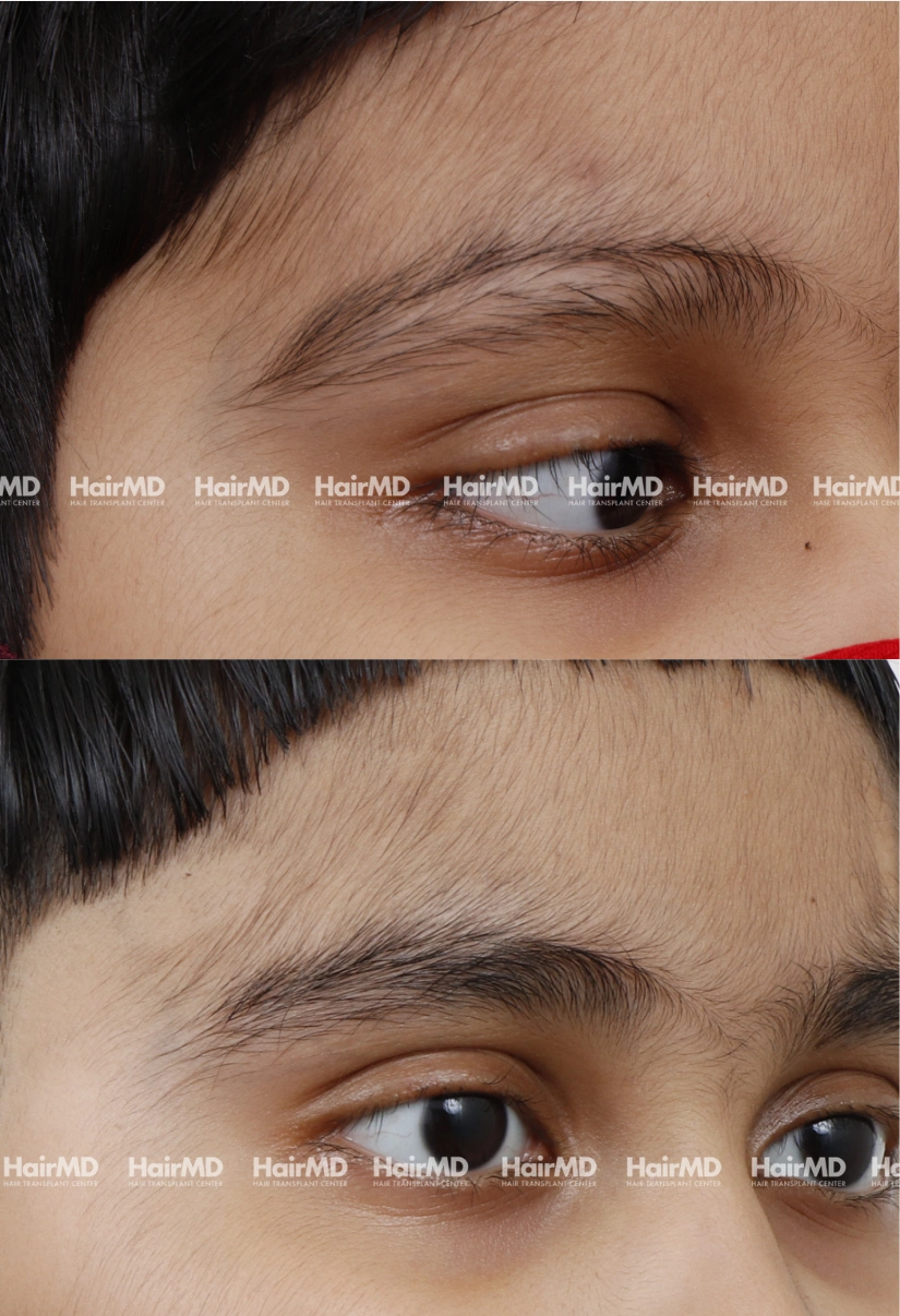 12yrs Alopecia areata Hairloss Results 4 Months Timeline 5 Sessions HairMD Pune