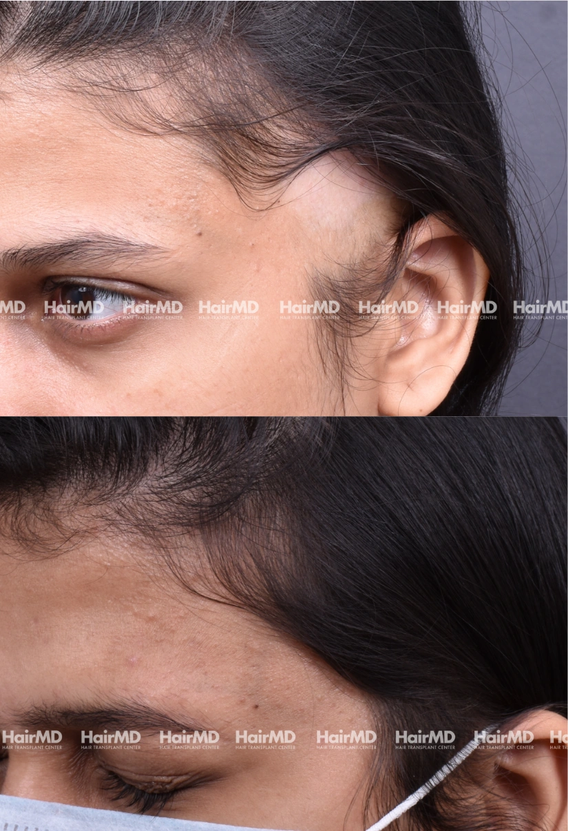 22yrs Alopecia areata Hairloss Results 6 Months Timeline 7 Sessions HairMD Pune