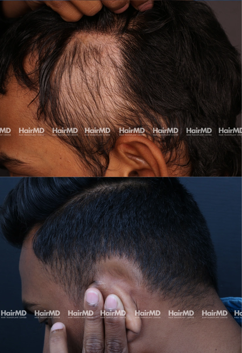 23yrs Alopecia areata Hairloss Results 5 Months Timeline 7 Sessions HairMD Pune