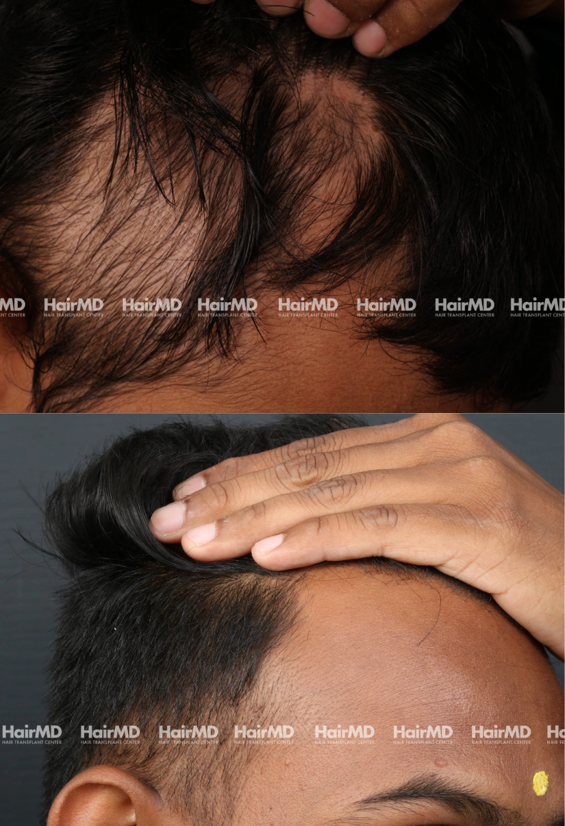 23yrs Alopecia areata Hairloss Results 5 Months Timeline 7 Sessions HairMD Pune