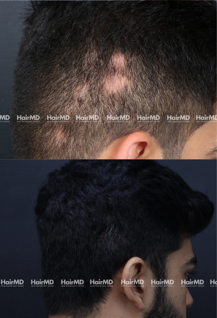 25yrs Alopecia areata Hairloss Results 6 Months Timeline 6 Sessions HairMD Pune