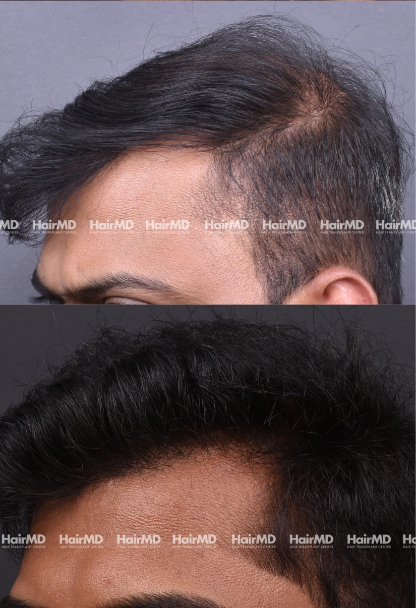 26yrs Male Hairtransplant Results 2 Years 3000-4000 Grafts HairMD Pune