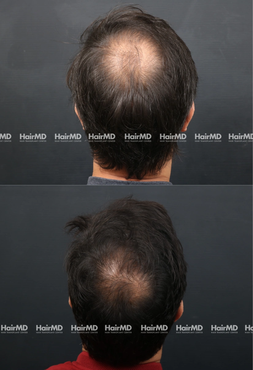 27yrs Alopecia areata Hairloss Results 3 Months Timeline 4 Sessions HairMD Pune