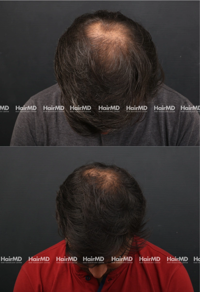 27yrs Alopecia areata Hairloss Results 3 Months Timeline 4 Sessions HairMD Pune