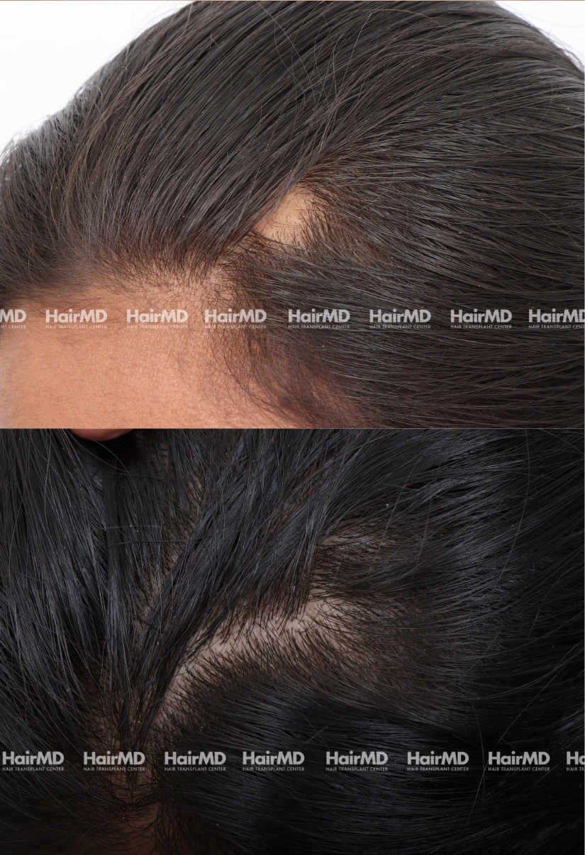 27yrs Alopecia areata Hairloss Results 3 Months Timeline 4 Sessions HairMD Pune