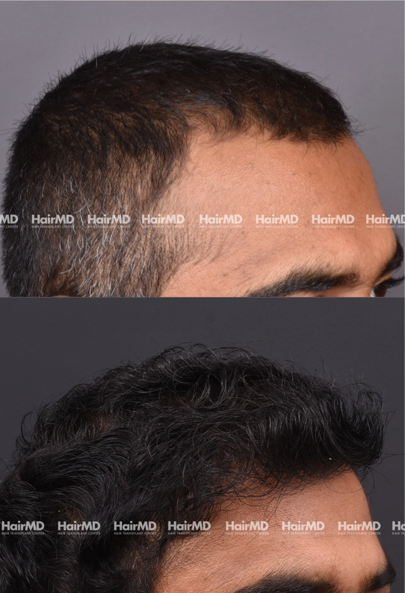 27yrs Male Hairtransplant Results 2 Years 3000-4000 Grafts HairMD Pune