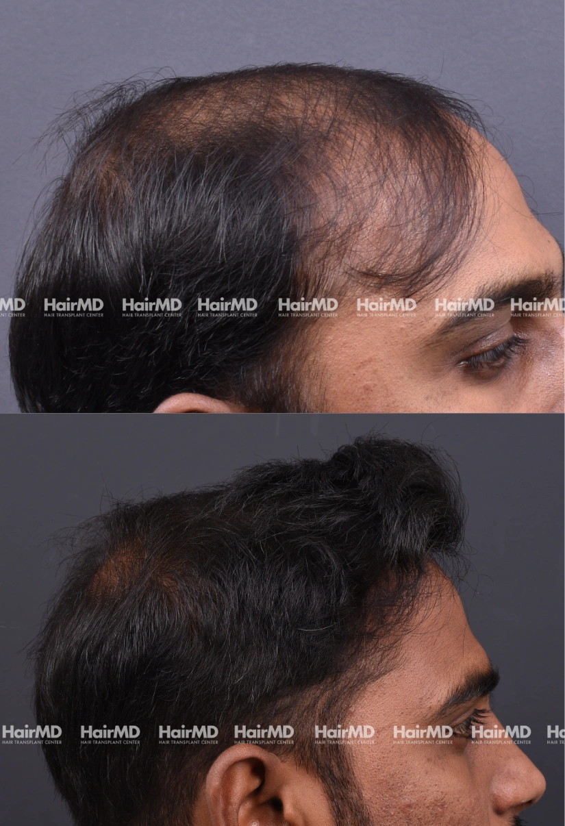 27yrs Male Hairtransplant Results 2 Years 4000-5000 Grafts HairMD Pune