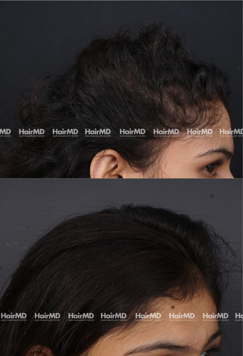 28yrs Female Hairloss Results 6 Months Timeline 7 Sessions HairMD Pune