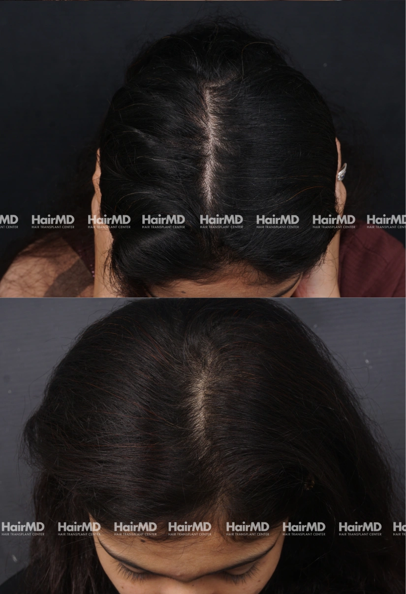 28yrs Female Hairloss Results 6 Months Timeline 7 Sessions HairMD Pune