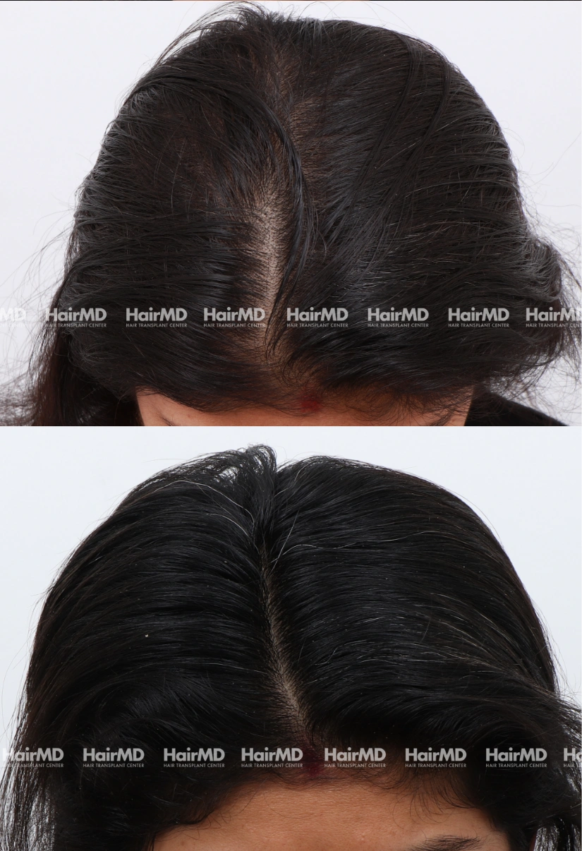 28yrs Female Hairloss Results 6 Months Timeline 7 Sessions HairMD Pune