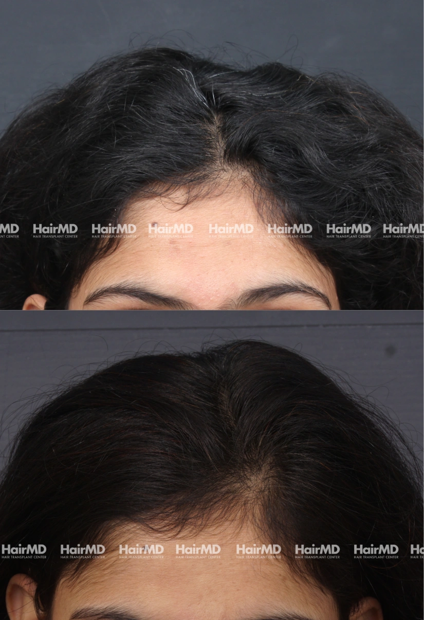 28yrs Female Hairloss Results 6 Months Timeline 7 Sessions HairMD Pune