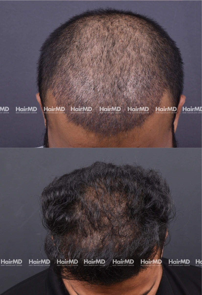 28yrs Male Hairtransplant Results 2 Years 2000-3000 Grafts HairMD Pune