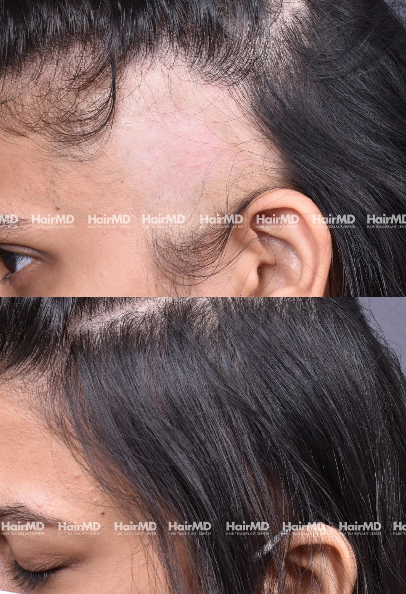 29yrs Alopecia areata Hairloss Results 6 Months Timeline 6 Sessions HairMD Pune