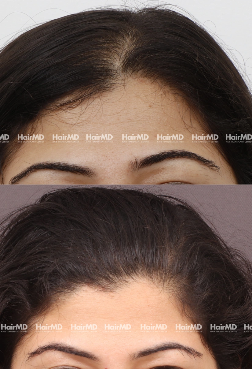 29yrs Female Hairloss Results 5 Months Timeline 5 Sessions HairMD Pune