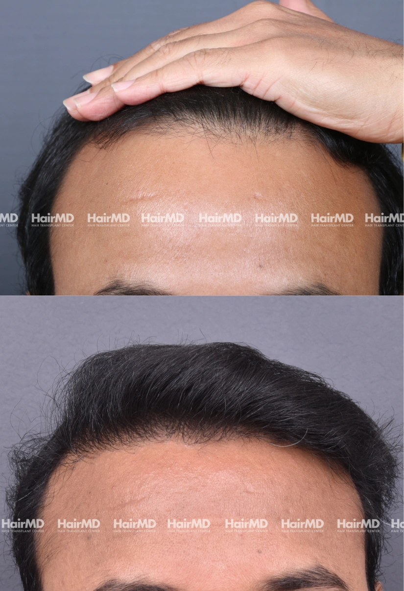 29yrs Male Hairtransplant 2 Years 4000-5000 Grafts HairMD Pune