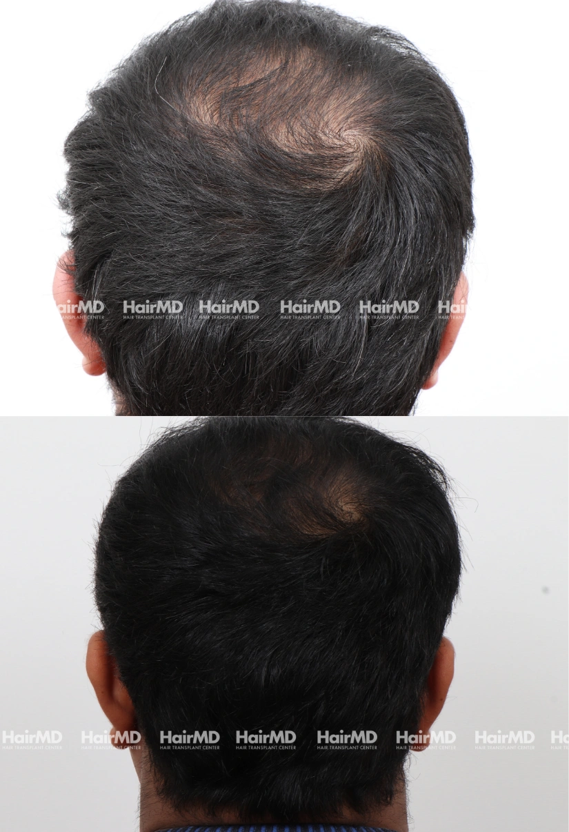 30yrs Baldness Hairloss Results 6 Months Timeline 7 Sessions HairMD Pune