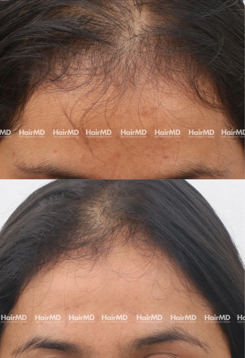 30yrs Female Hairloss Results 4 Months Timeline 5 Sessions HairMD Pune