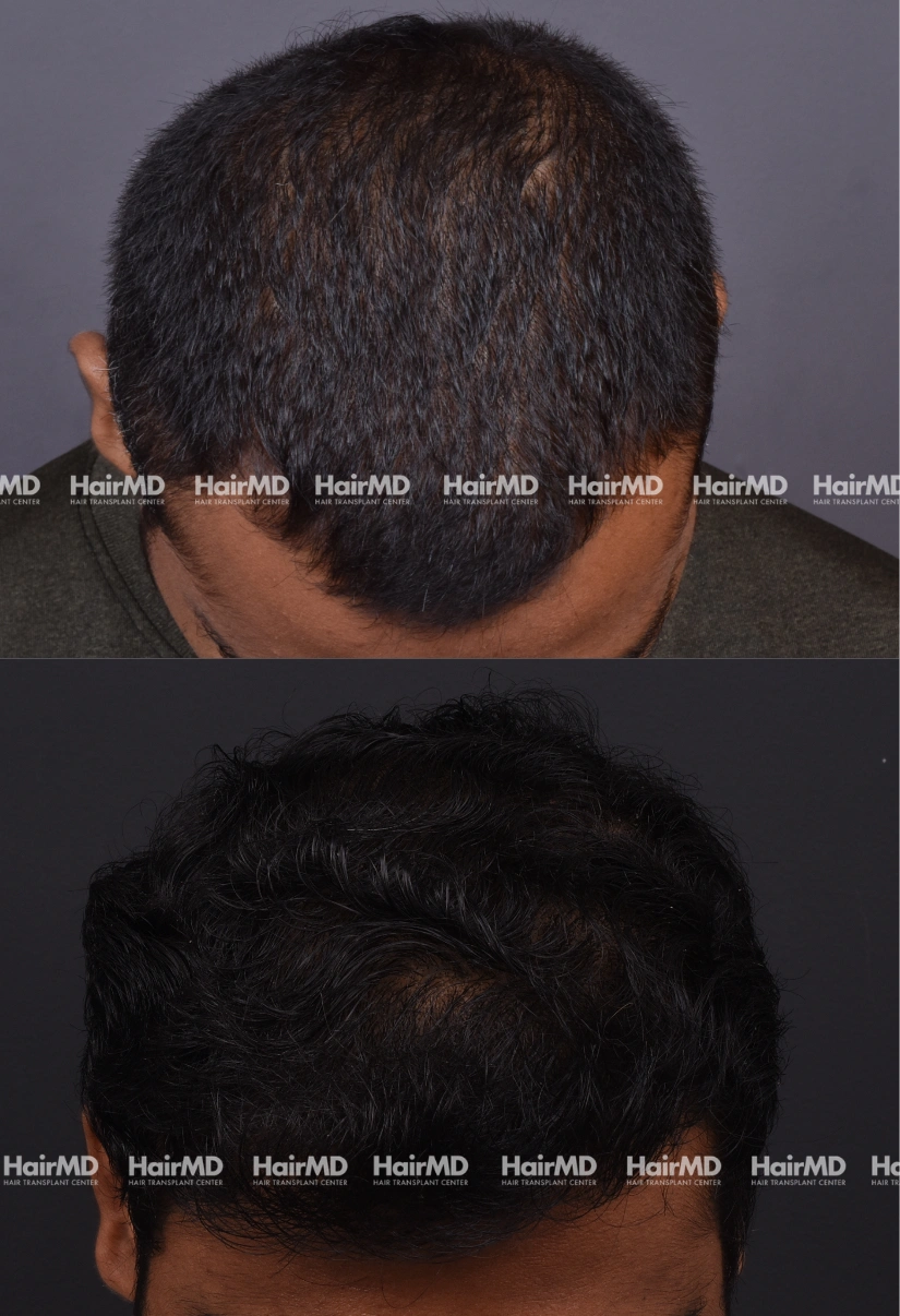 30yrs Male Hairtransplant Results 2 Years 3000-4000 Grafts HairMD Pune