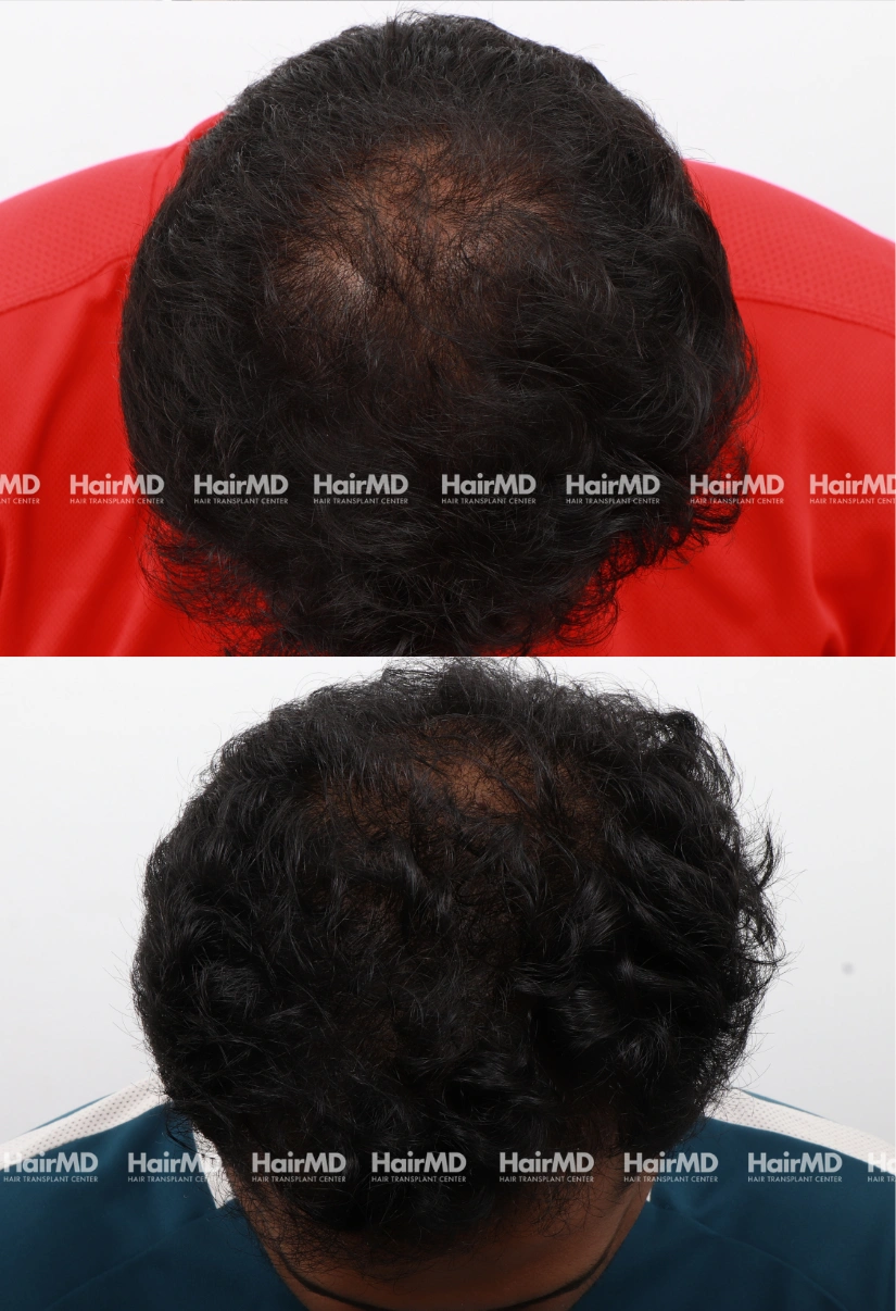 30yrs Nutritional hairloss Results 6 Months Timeline 7 Sessions HairMD Pune