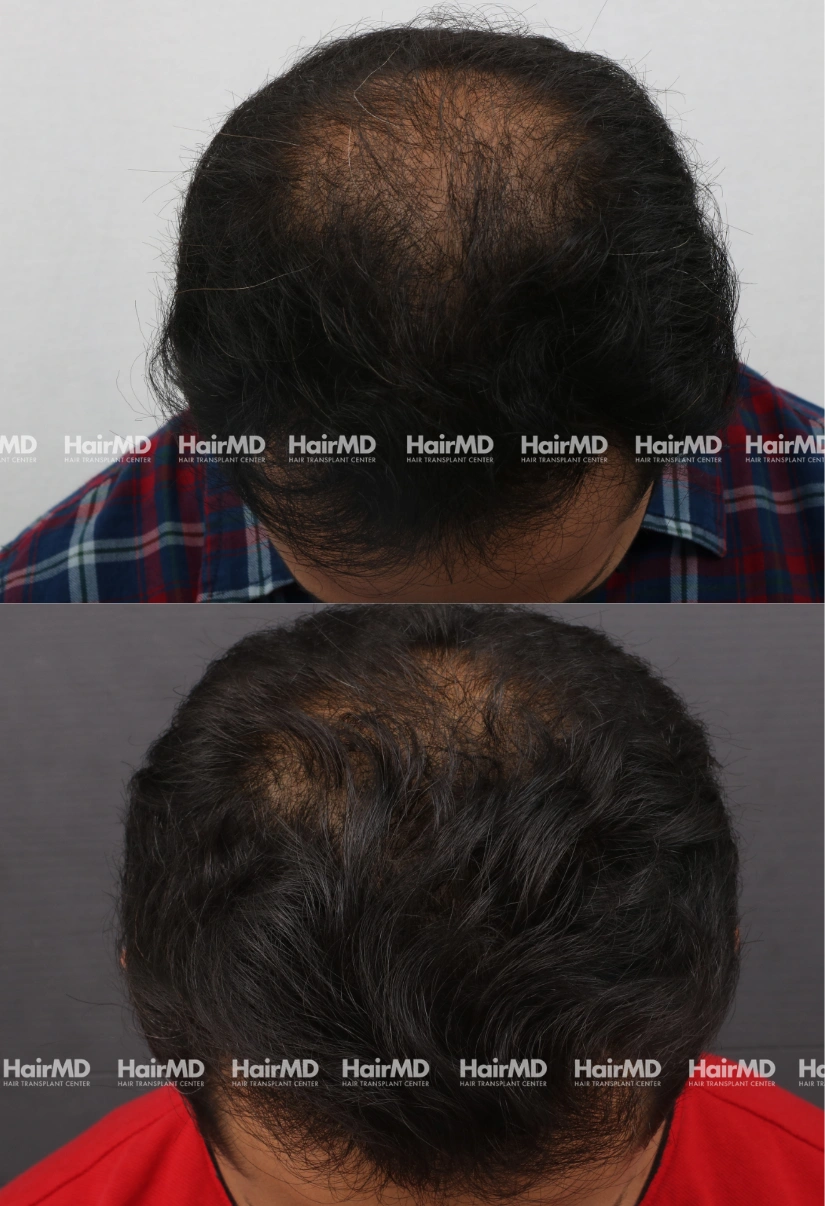 31yrs Baldness Hairloss Results 5 Months Timeline 6 Sessions HairMD Pune