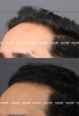 31yrs Male Hairloss Results 4 Months Timeline 5 Sessions HairMD Pune