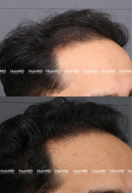 31yrs Male Hairloss Results 4 Months Timeline 5 Sessions HairMD Pune