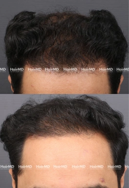 31yrs Male Hairloss Results 4 Months Timeline 5 Sessions HairMD Pune