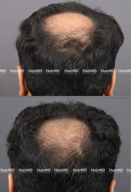 31yrs Male Hairloss Results 4 Months Timeline 5 Sessions HairMD Pune