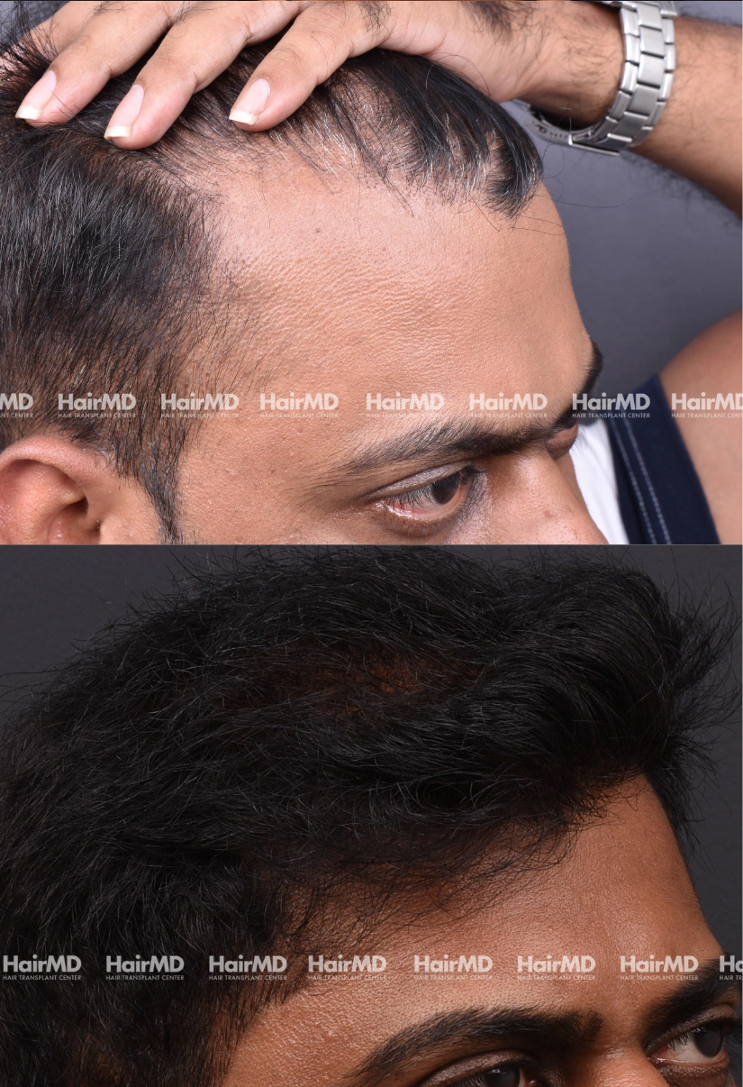 31yrs Male Hairtransplant Results 2 Years 3000-4000 Grafts HairMD Pune