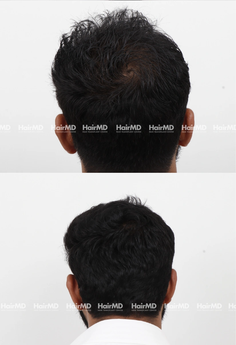 31yrs Nutritional hairloss Results 6 Months Timeline 6 Sessions HairMD Pune