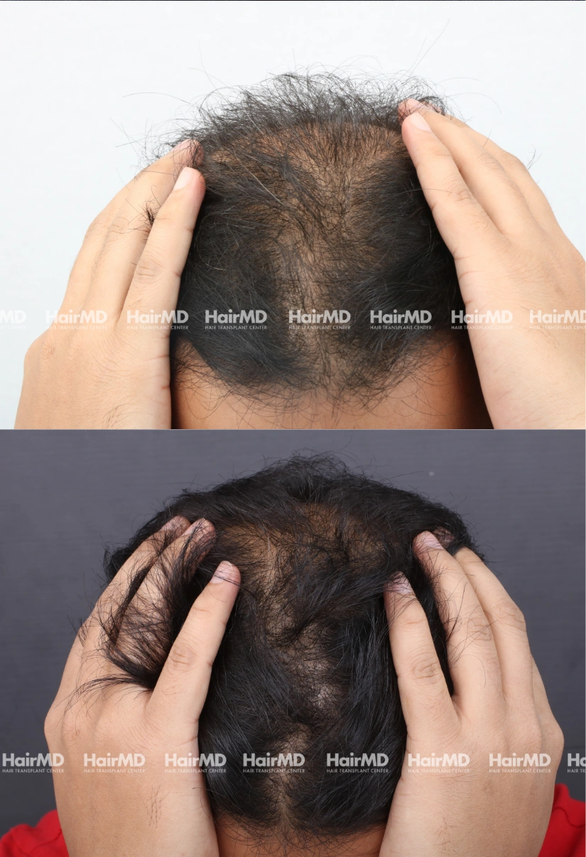 32yrs Baldness Hairloss Results 6 Months Timeline 6 Sessions HairMD Pune