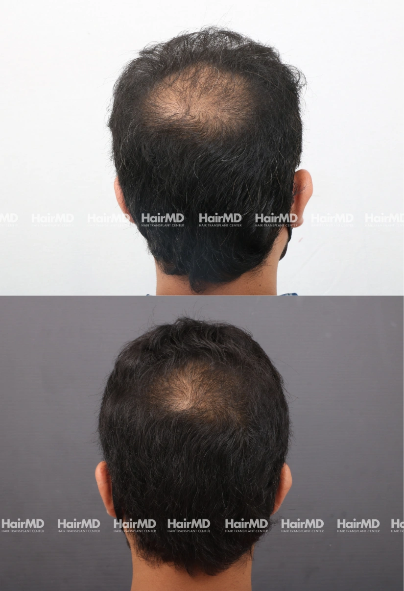 32yrs Baldness Hairloss Results 6 Months Timeline 6 Sessions HairMD Pune