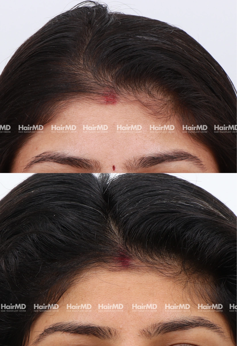 32yrs Female Hairloss Results 5 Months Timeline 6 Sessions HairMD Pune