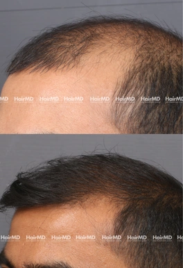 32yrs Male Hairloss Results 5 Months Timeline 6 Sessions HairMD Pune