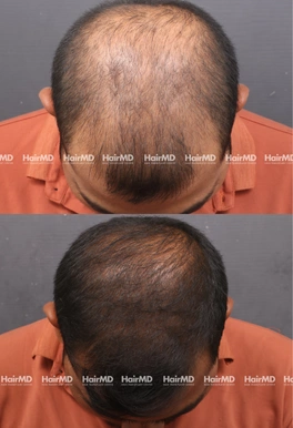 32yrs Male Hairloss Results 5 Months Timeline 6 Sessions HairMD Pune