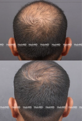 32yrs Male Hairloss Results 5 Months Timeline 6 Sessions HairMD Pune