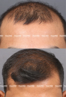 32yrs Male Hairloss Results 5 Months Timeline 6 Sessions HairMD Pune