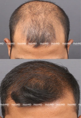 32yrs Male Hairloss Results 5 Months Timeline 6 Sessions HairMD Pune