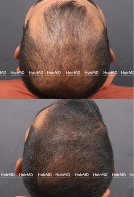 32yrs Male Hairloss Results 5 Months Timeline 6 Sessions HairMD Pune