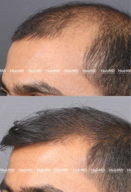 32yrs Male Hairloss Results 5 Months Timeline 6 Sessions HairMD Pune