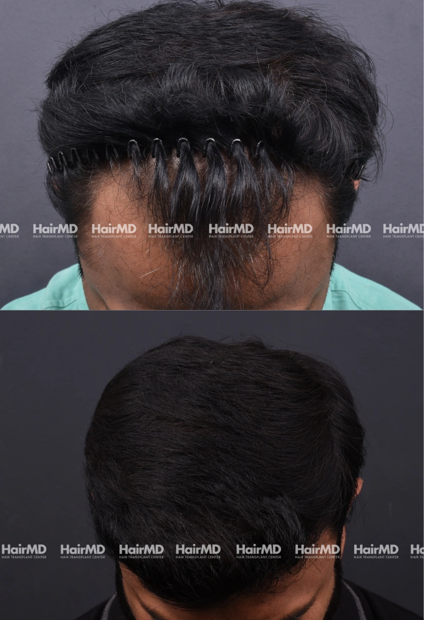 32yrs Male Hairtransplant 2 Years 2000-3000 Grafts HairMD Pune