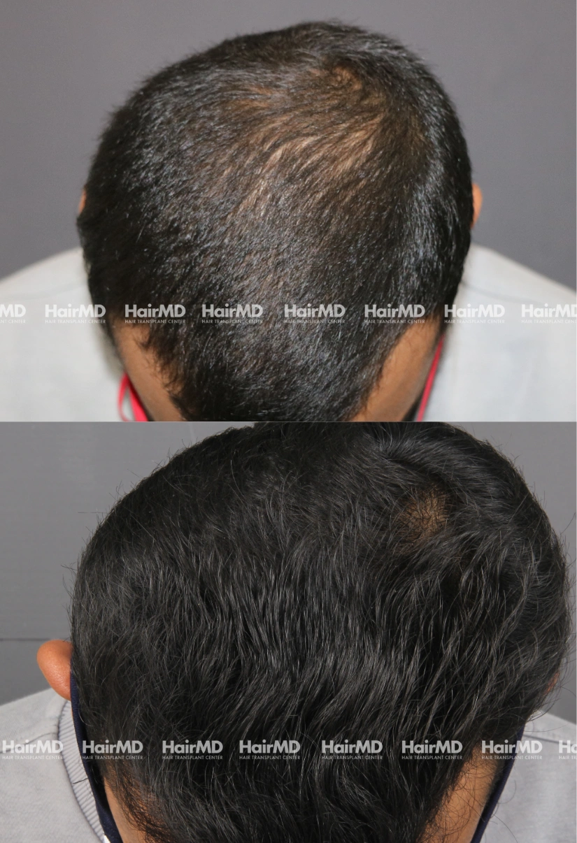 32yrs Nutritional hairloss Results 6 Months Timeline 7 Sessions HairMD Pune