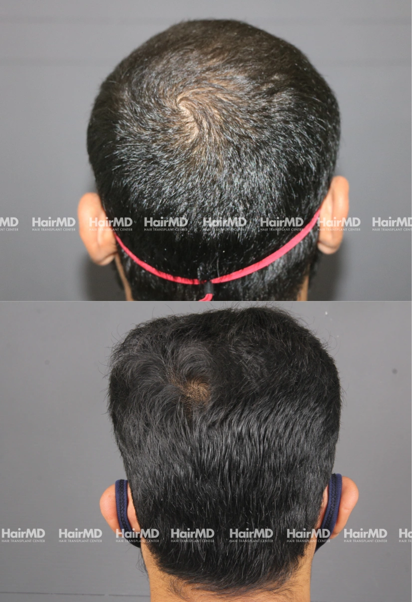 32yrs Nutritional hairloss Results 6 Months Timeline 7 Sessions HairMD Pune